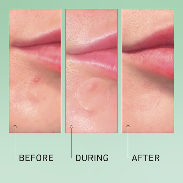 Luna Pimple Patches