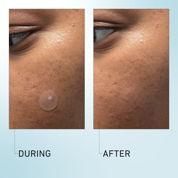 Luna Pimple Patches